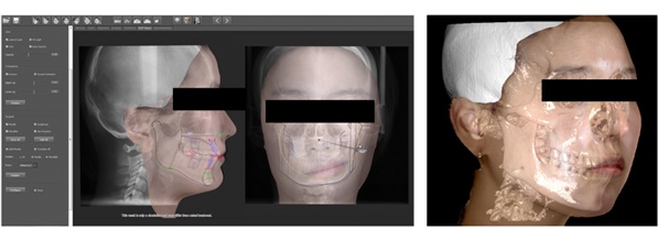 그림 3. (좌)교정 치료 및 악교정 수술의 3차원 시뮬레이션 기능, (우) CBCT 데이터와 3차원 안면 스캔데이터의 중첩