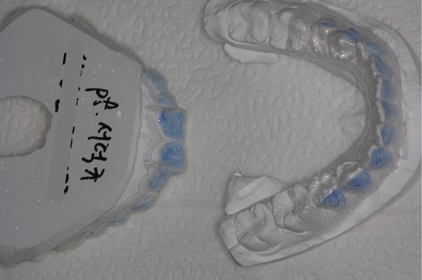 치아를 본뜬 후 제작된 자가미백술용 치아틀(투명색).