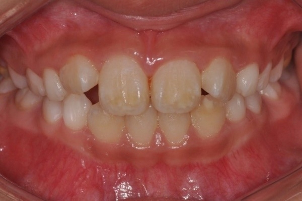 [사진 1] 갓 나온 영구치 전치(앞니)에서 관찰되는 저광화. 위·아래 전치의 치아 색이 주변과 다른 것을 확인할 수 있다.