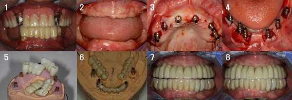 사진2= 임플란트 고정성 크라운 보철치료. 제3의 치아로 리모델링이 완성됐다.