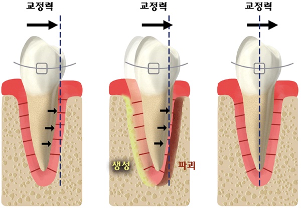 치아교정 치료에서 치아가 움직이는 원리.