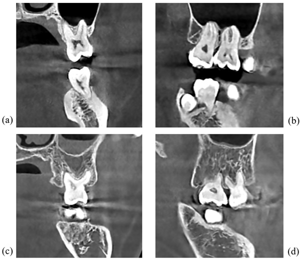 치아 뿌리가 상악동 동굴 내부로 들어간 CBCT 사진(A, B)과 상악동 동굴 내부로 들어가지 않은 CBCT 사진(C, D). A, C는 관상면(신체를 앞뒤로 나누는 가상의 면) B, D는 시상면(신체를 좌우로 나누는 가상의 면).