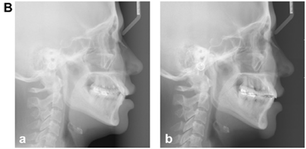 [그림3] 덧니가 심한 환자의 비발치 교정치료. A, 치료 전 구내사진(a, c), 치료 후 구내사진(b, d). B, 치료 전 측방두부규격 엑스레이(a), 치료 후 측방두부규격 엑스레이(b).