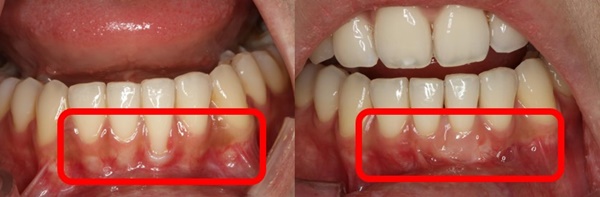 [사진2] 잇몸이식술을 통해 노출된 치근면을 덮기 전(왼쪽)과 치료 후 모습.